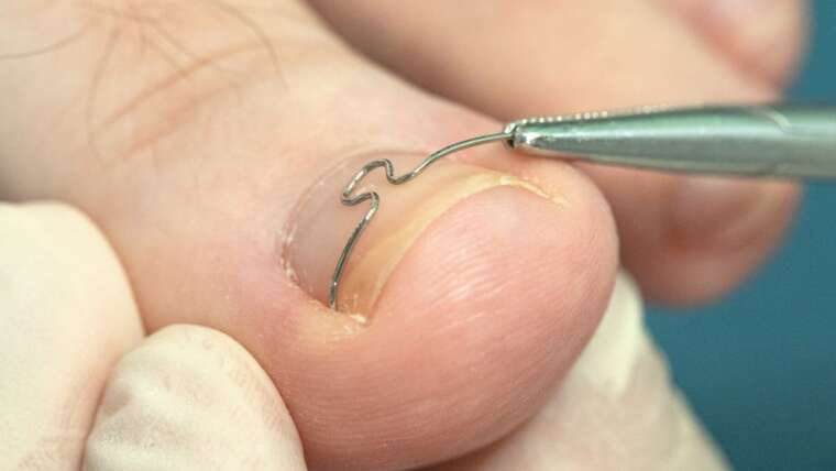 Plastyka wałów paznokciowych